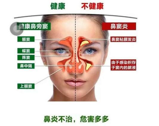 10年鼻窦炎患者, 自述康复过程 - 知乎